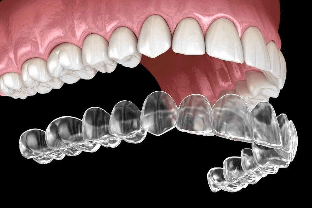 Braces & Aligners