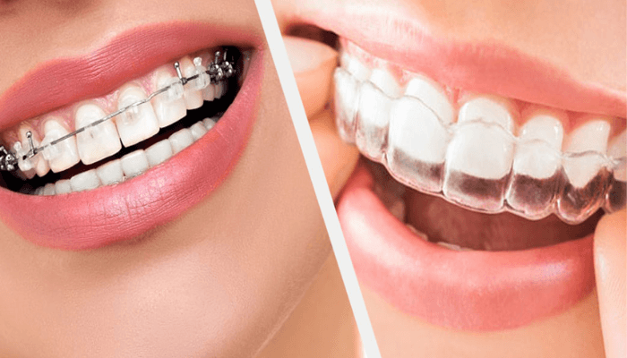 Braces & Aligners