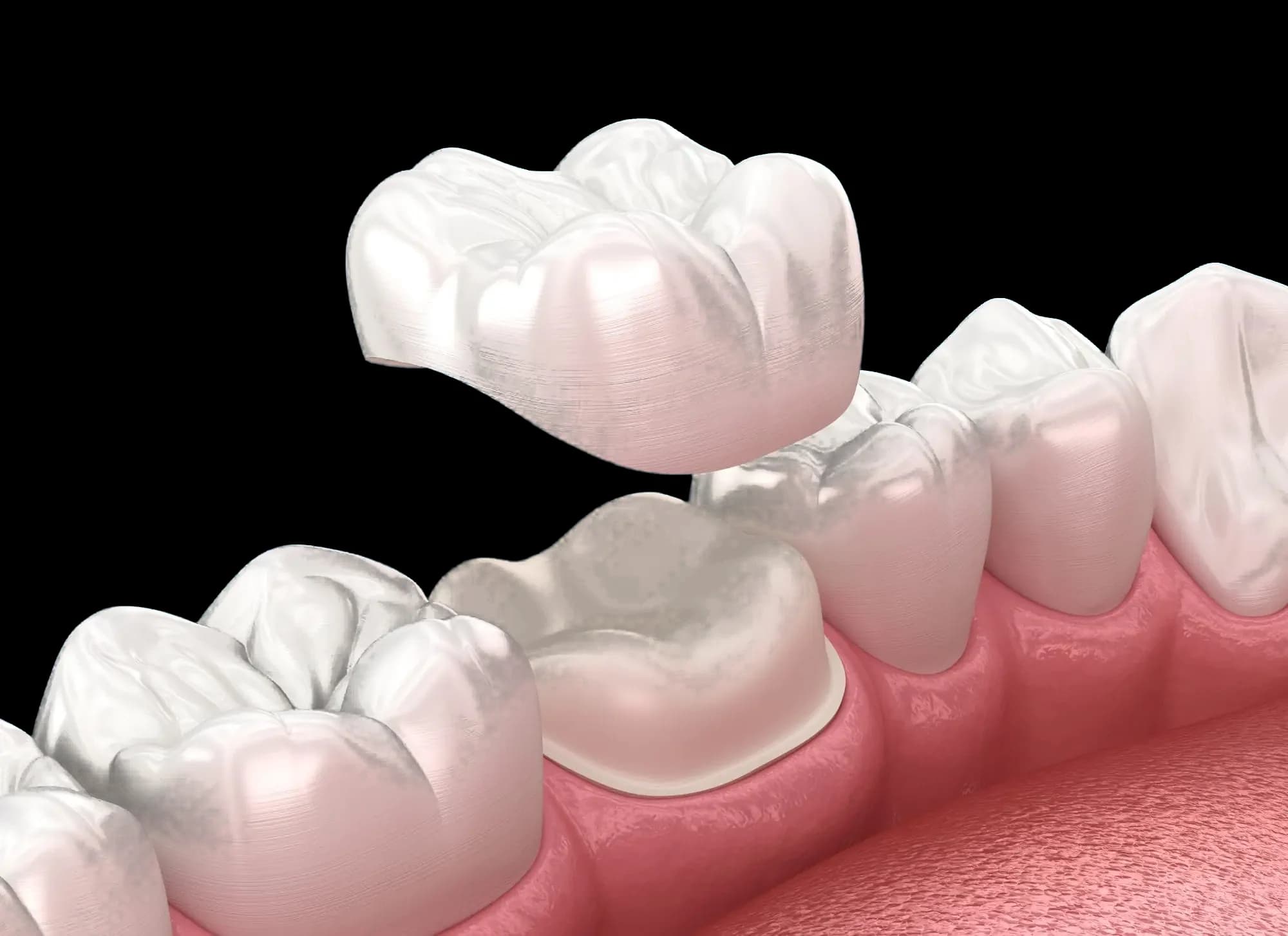 Dental Crowns & Bridges