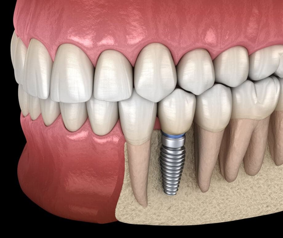 Dental Implants