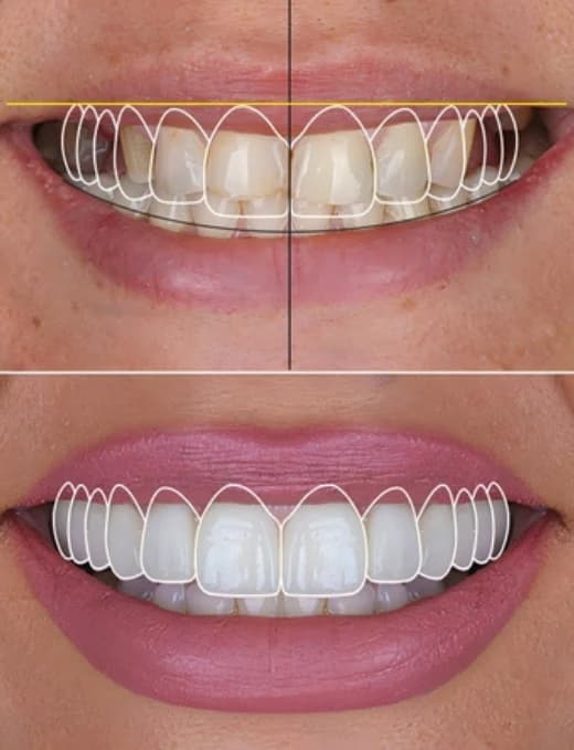 Smile Designing
