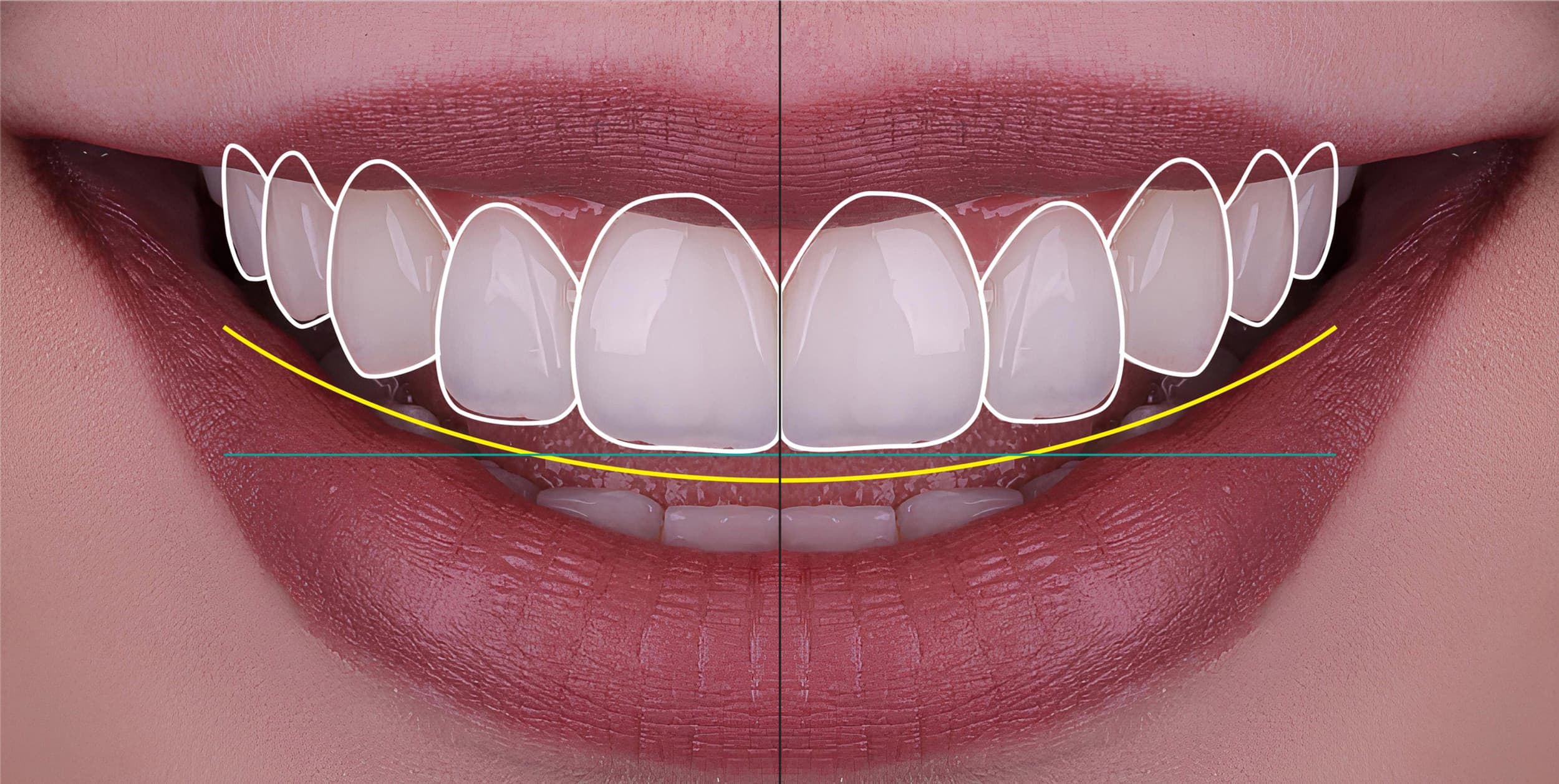 Smile Designing